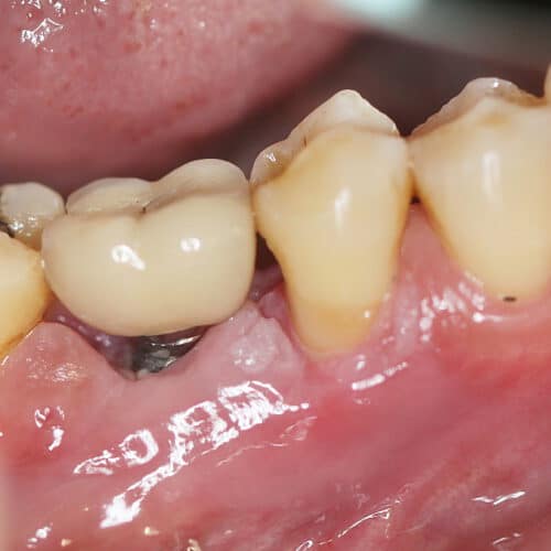 PerioTabs®, la toute dernière innovation de bonyf, est plus performant que la chlorhexidine pour traiter les infections liées aux implants dentaires.