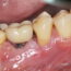 treating dental implant related infections