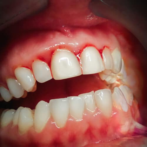 Nouvelle donnée clinique prouvant que PerioTabs® réduit le saignement des gencives et l’accumulation de la plaque dentaire.