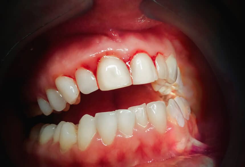 Nouvelle donnée clinique prouvant que PerioTabs® réduit le saignement des gencives et l’accumulation de la plaque dentaire.