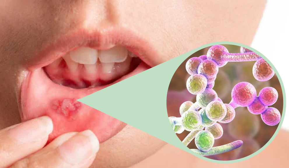 Advanced R&D capabilities and proven efficacy of our unique fast pain-relief mouth ulcer cream
